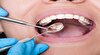 ارتباط بیماری‌های دهان با بروز برخی سرطان‌ها