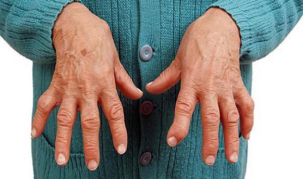 آرتریت روماتوئید چیست؟