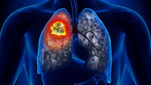 کرم هایی که سرطان ریه را تشخیص می دهند