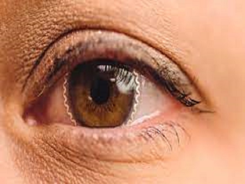 چاقی با بیماری چشمی دژنراسیون ماکولا مرتبط است