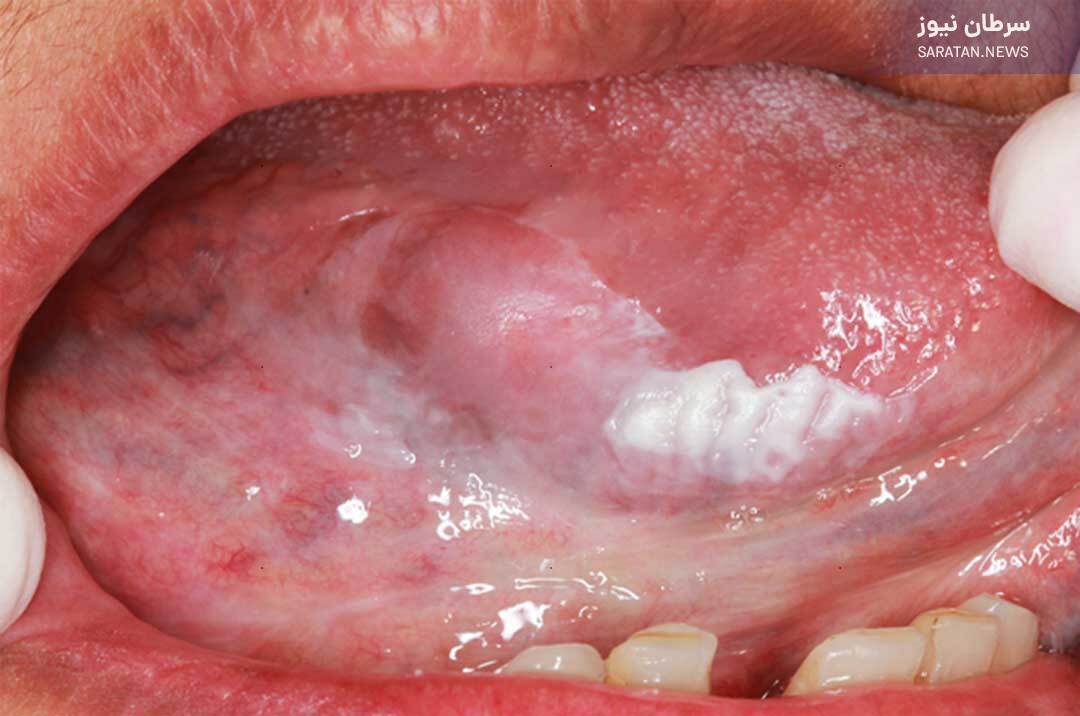 این علائم نشان دهنده سرطان دهان است
