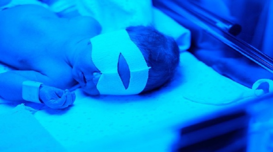 چرا نوزاد زردی می گیرد/ اهمیت درمان عفونت کلیه