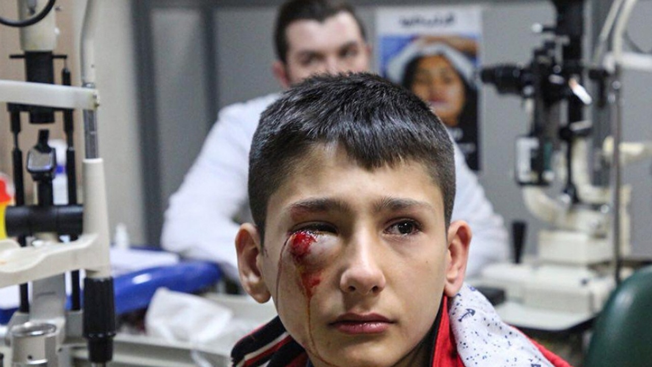 آسیب‌های چشمی ناشی از مواد مفنجره در چهارشنبه سوری کدامند؟