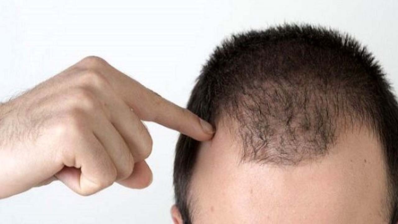 کچلها بیشتر کرونا میگیرند؟