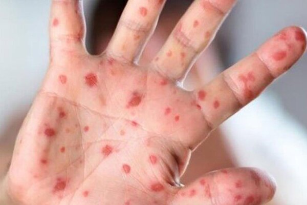 ابتلای ۹۶ نفر به سرخک در کشور