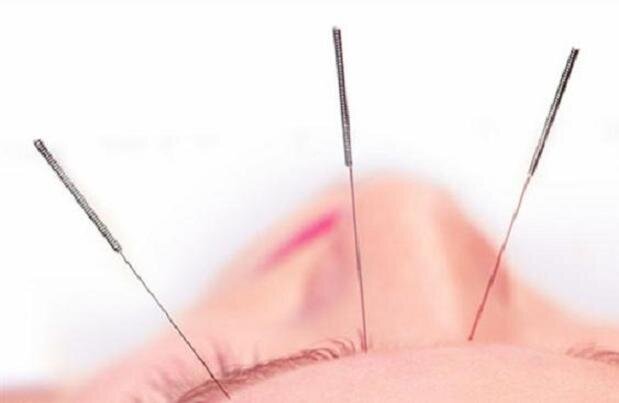 طب سوزنی در کاهش سردردهای تنشی موثر است