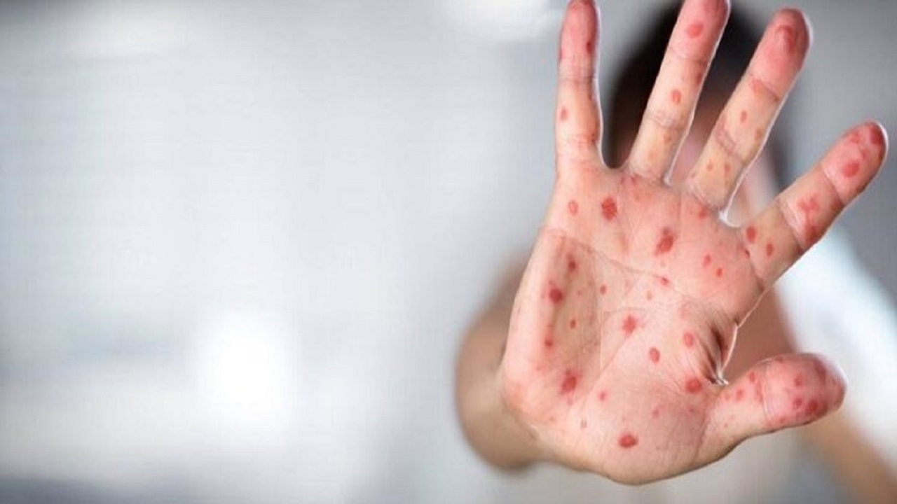 رییس مرکز بهداشت خوزستان: وضعیت عمومی بیمار مبتلا به آبله میمونی در اهواز مناسب است