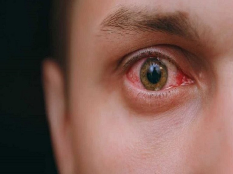همه چیز درباره آلرژی چشم