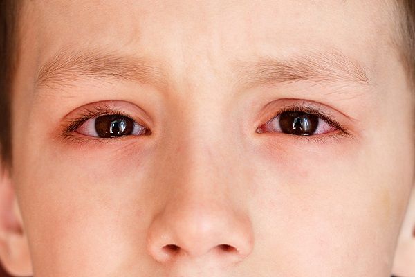 شایع ترین بیماری های چشمی دوران کودکی را بشناسیم