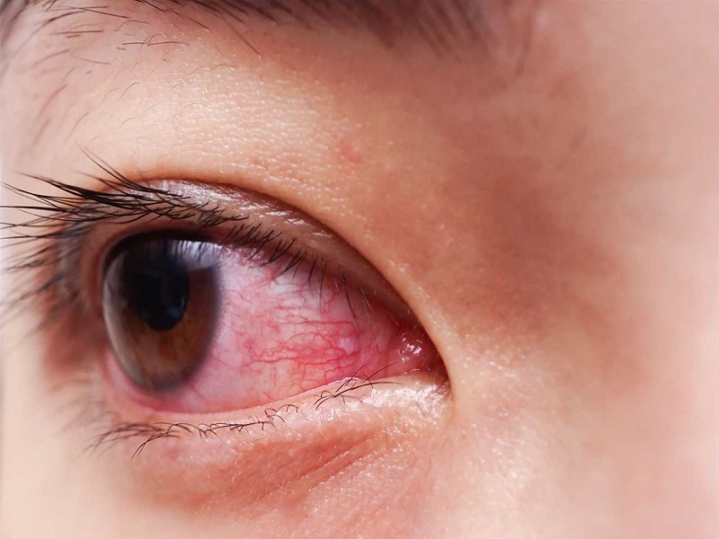 درمان کرونا با داروی چشم
