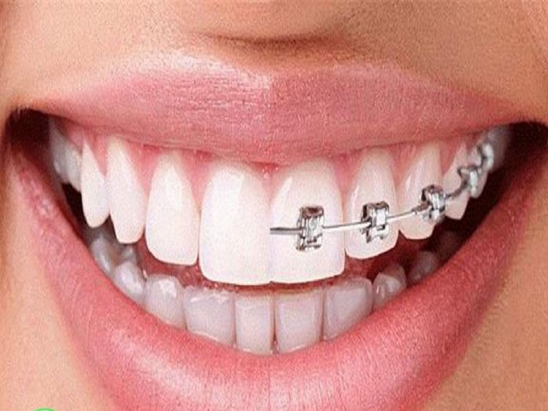 روش‌های درمان دندان‌های کج / خوب و بد جایگزین های ارتودنسی