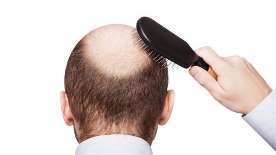 آیا مکمل بیوتین در جلوگیری از ریزش مو موثر است؟