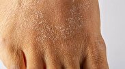چند توصیه برای مقابله با خشکی پوست در زمستان