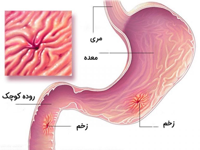 علائم هشدار زخم معده را جدی بگیرید/ کاهش چشمگیر شیوع زخم معده در کشور علائم زخم معده