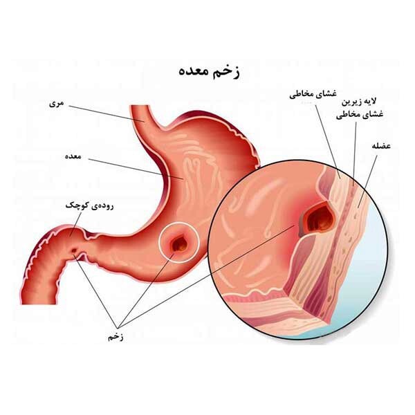 علائم هشدار زخم معده را جدی بگیرید/ کاهش چشمگیر شیوع زخم معده در کشور زخم معده