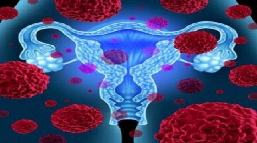 فیبروم و آندومتریوز احتمال سرطان تخمدان را افزایش می دهد