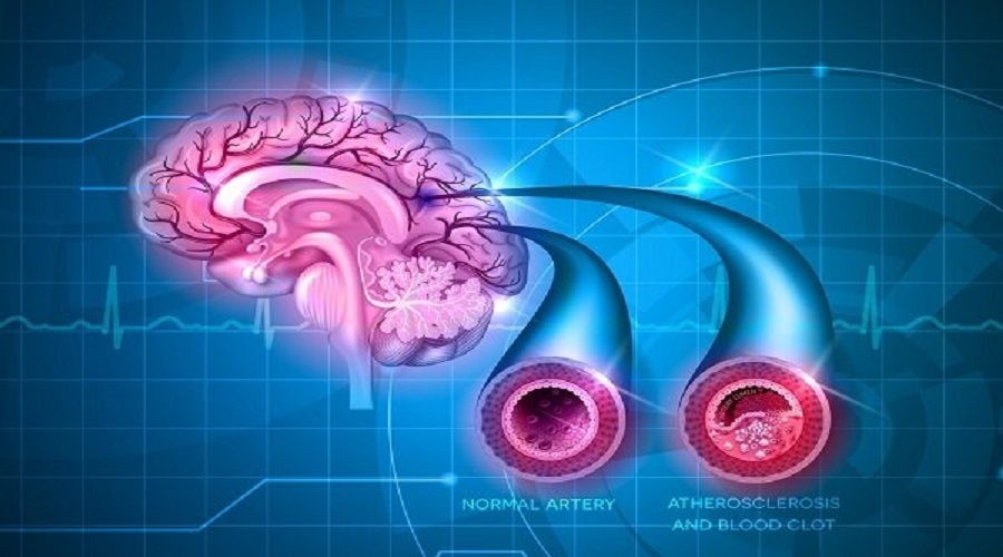 تاثیر استاتین در کاهش ریسک سکته در مبتلایان فیبریلاسیون دهلیزی