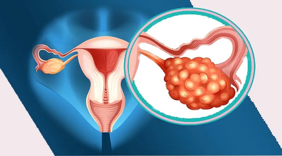 افزایش سرطان تخمدان در زنان مبتلا به سندرم تخمدان پلی کیستیک