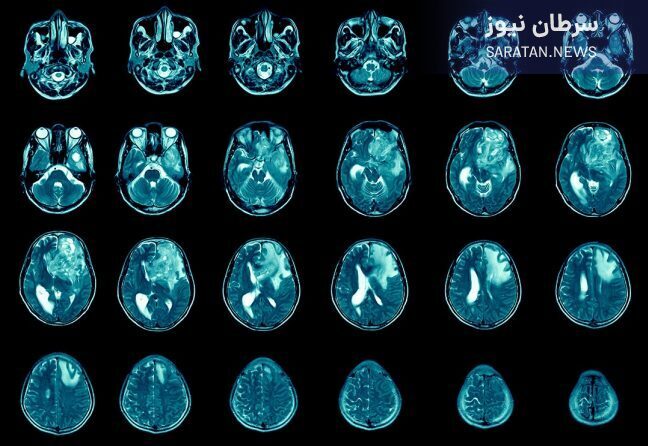 تومور مغزی گلیوبلاستوما چیست؟ تومور مغزی گلیوبلاستوما چیست؟