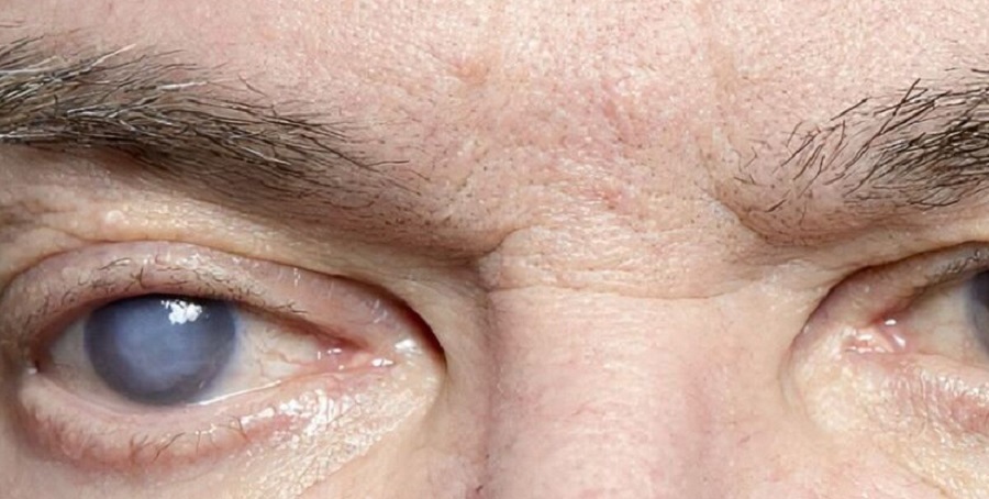 کارایی داروی التهاب روده برای چشم