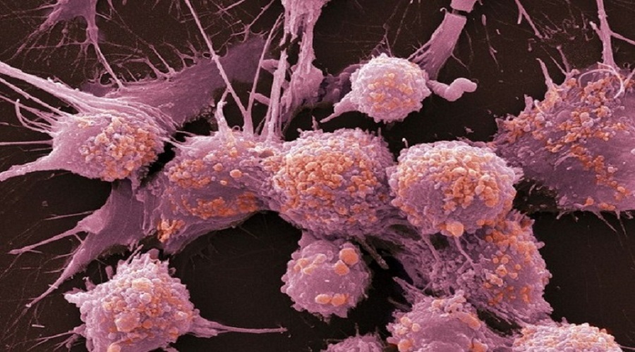 امیدی جدید برای بیماران مبتلا به سرطان پروستات مقاوم به اخته شدن متاستاتیک