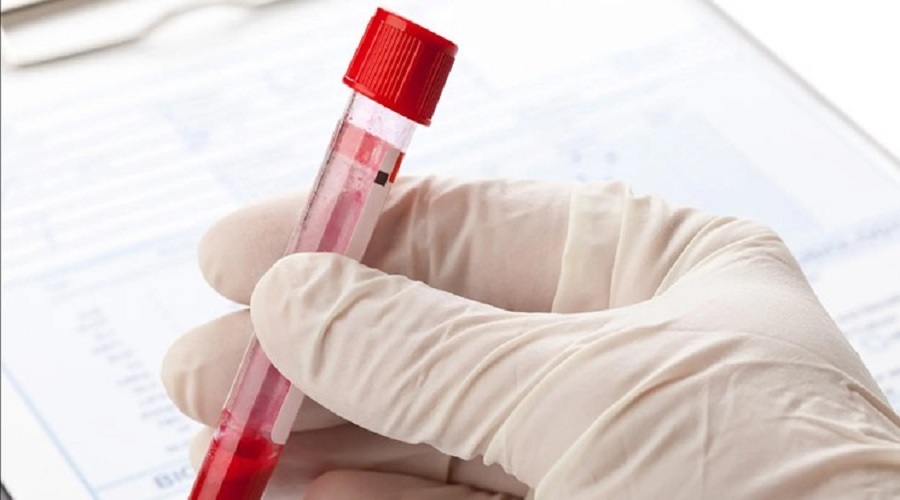 تشخیص سرطان تخمدان با یک آزمایش خون