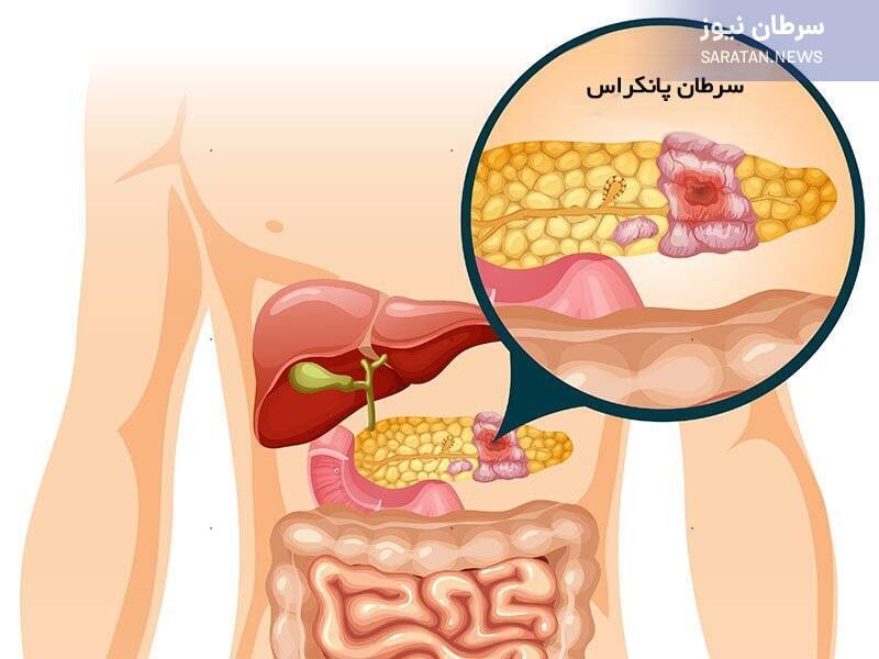علائم و نشانه های سرطان پانکراس علائم سرطان پانکراس
