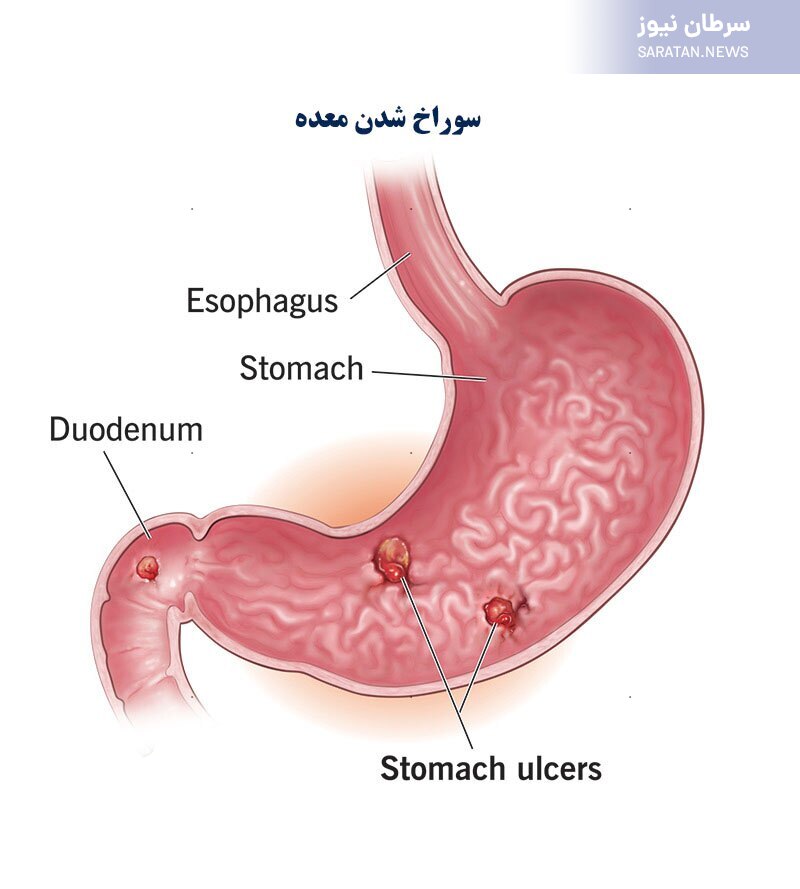 علائم و علتهای سوراخ شدن معده چیست؟ علائم سوراخ شدن معده