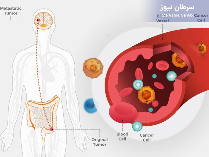 هر آنچه از سرطان باید بدانید متاستاز