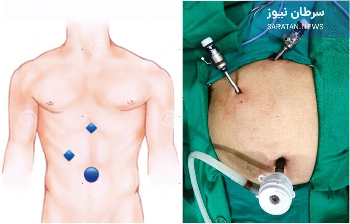 نمونه برداری کبد چیست و چه زمانی انجام می شود؟ نمونه برداری کبد