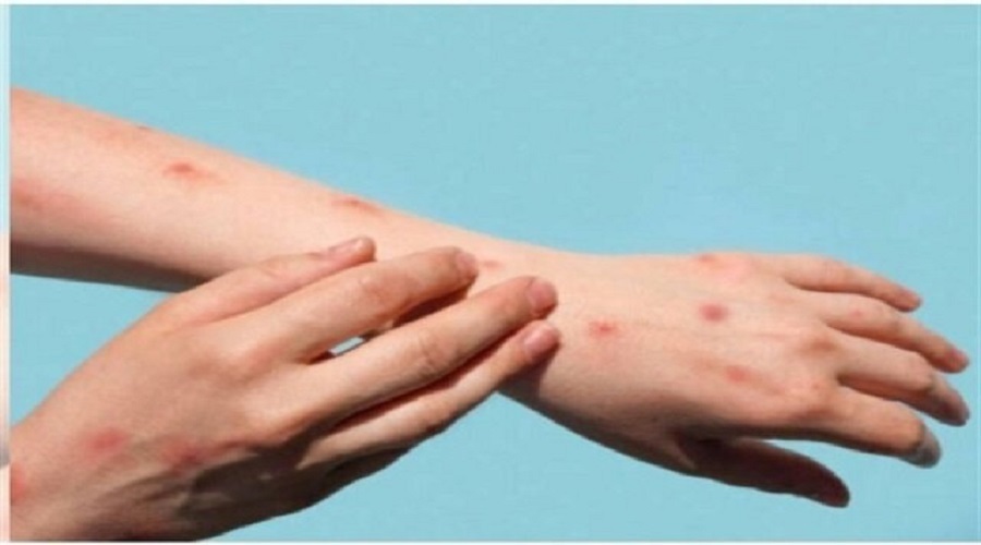 چرا سویه جدید آبله میمونی می تواند خطرناک باشد؟
