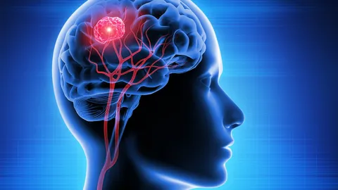 تومورهای مغزی و نقش روش‌های نوین رادیوتراپی در درمان