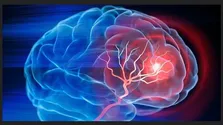 افزایش سکته‌های مغزی به دنبال تنهایی