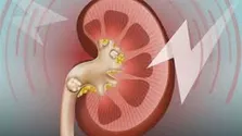 پیشگیری از سکته و نارسایی قلبی با رژیم غذایی مخصوص دیابتی‌ها
