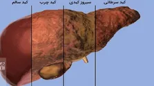 شناسایی مسیر‌های پیام رسانی سلول‌های سرطانی کبد توسط محققان کشور