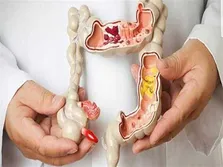 کاهش سطح آمونیاک، تومورهای سرطانی را به درمان ایمونوتراپی حساس‌تر می کند