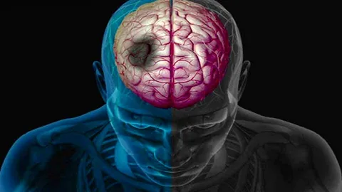 نشانه‌های مهم سکته مغزی چیست؟