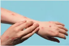 آیا آبله هنوز برای دنیا یک تهدید محسوب می‌شود؟