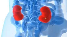 چرایی شیوع و علائم سنگ کلیه