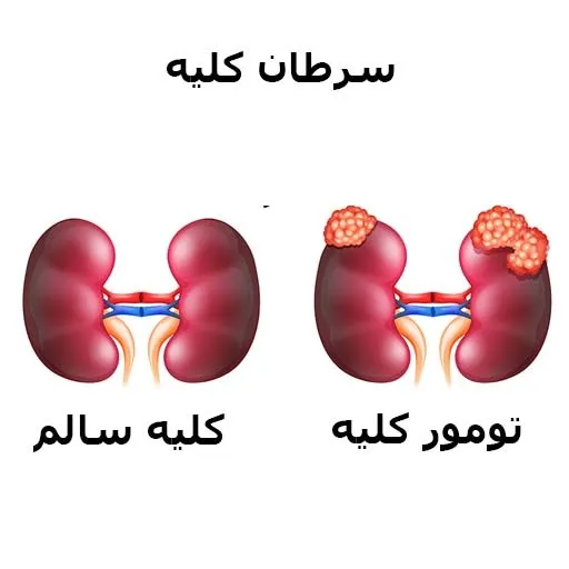 آیا می توان سرطان کلیه را به طور طبیعی درمان کرد؟