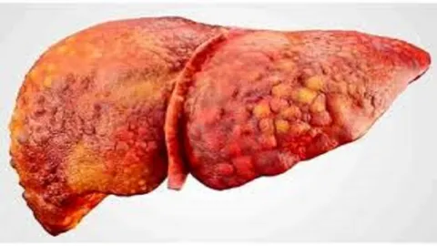 چرا بیماری کبد چرب در جامعه شیوع پیدا کرده است؟