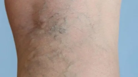 با چند عادت ساده از ابتلا به واریس پیشگیری کنیم
